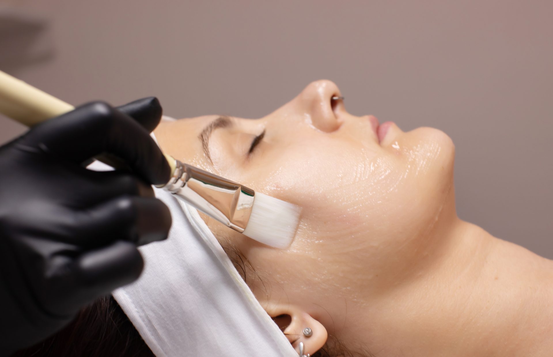 chemical peel treatment